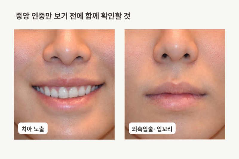 3D 무흉인중축소·비주인중축소, 누구에게 잘 맞을까요? 사진 7