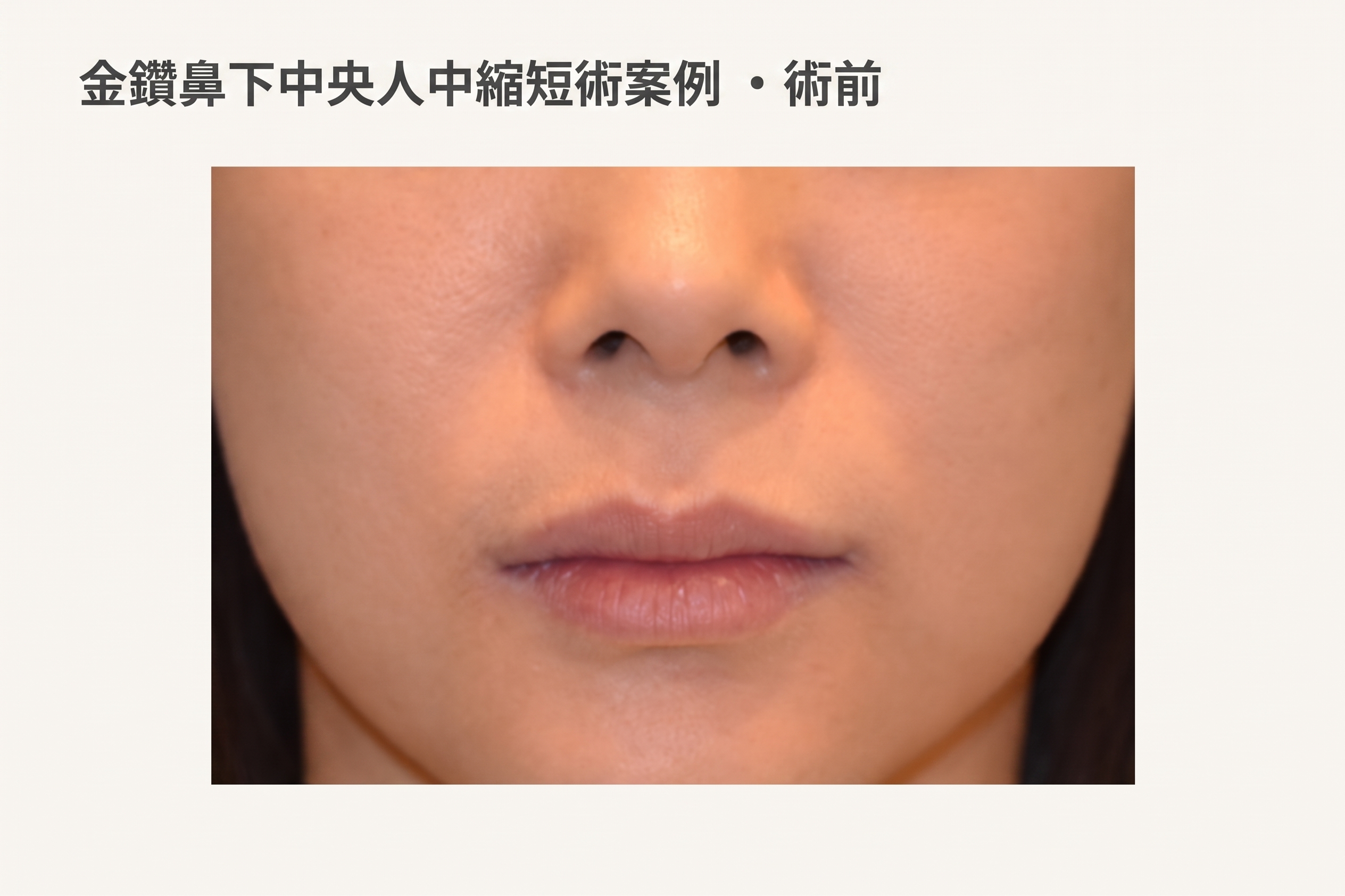 金色鑽石鼻下中央人中縮短案例