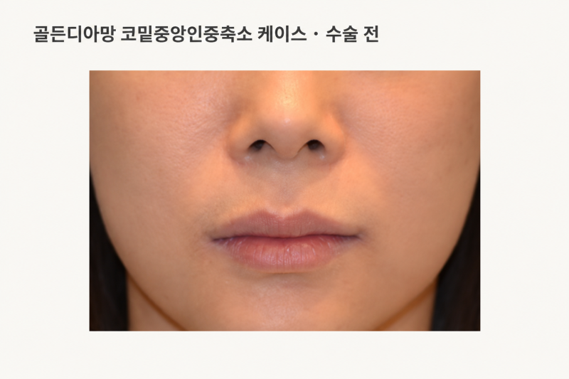 3D 무흉인중축소·비주인중축소, 누구에게 잘 맞을까요?