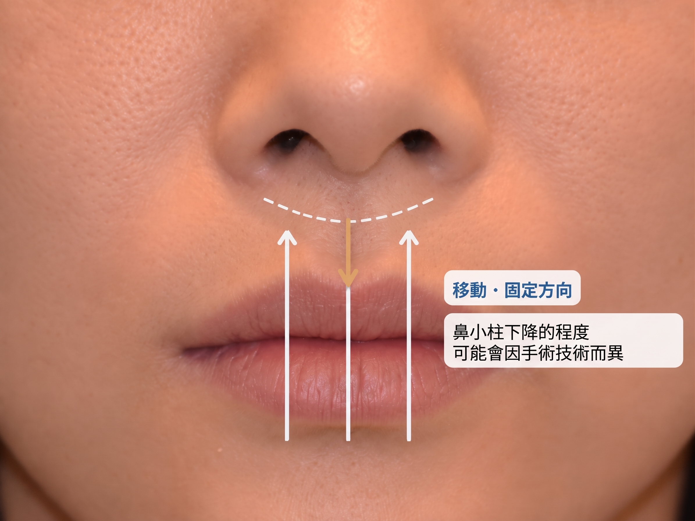 鼻下中央人中縮短與鼻小柱下垂變化