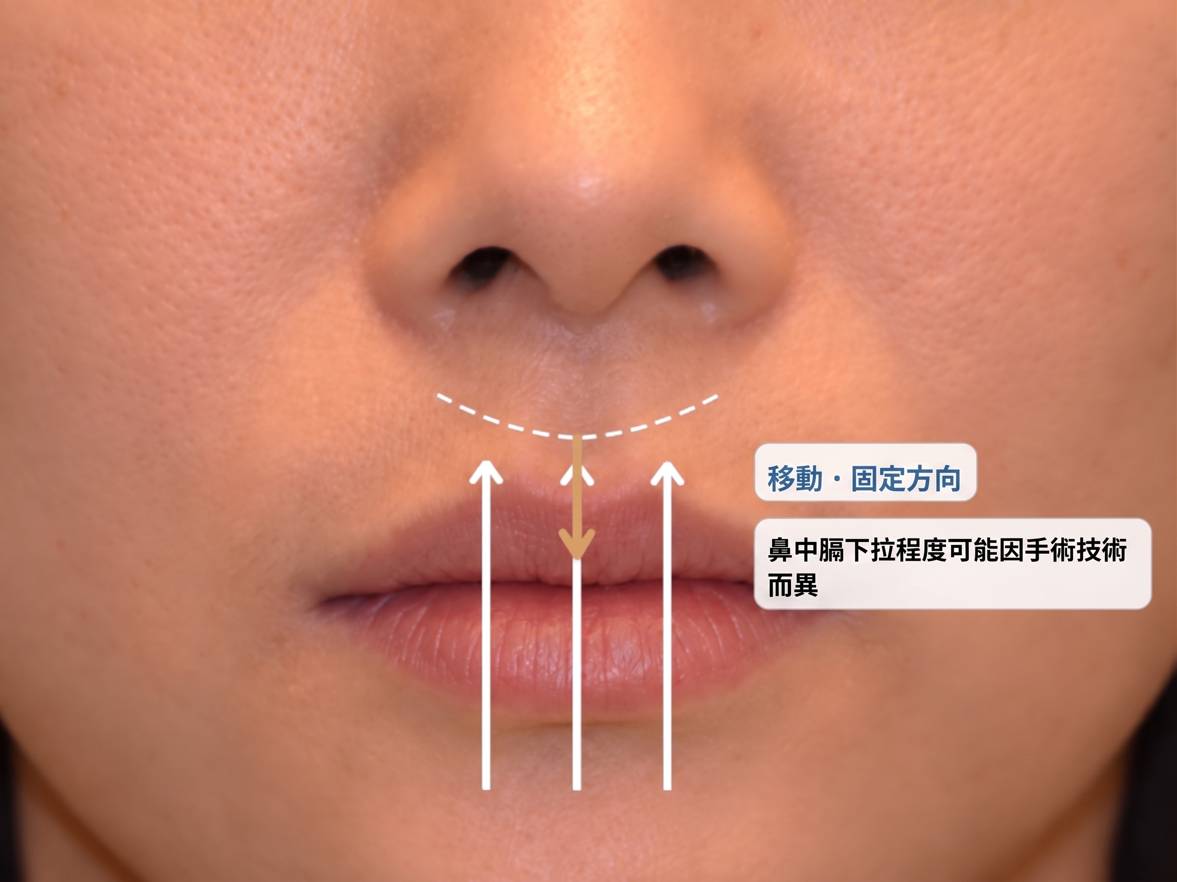 手術切開與張力分散方式比較
