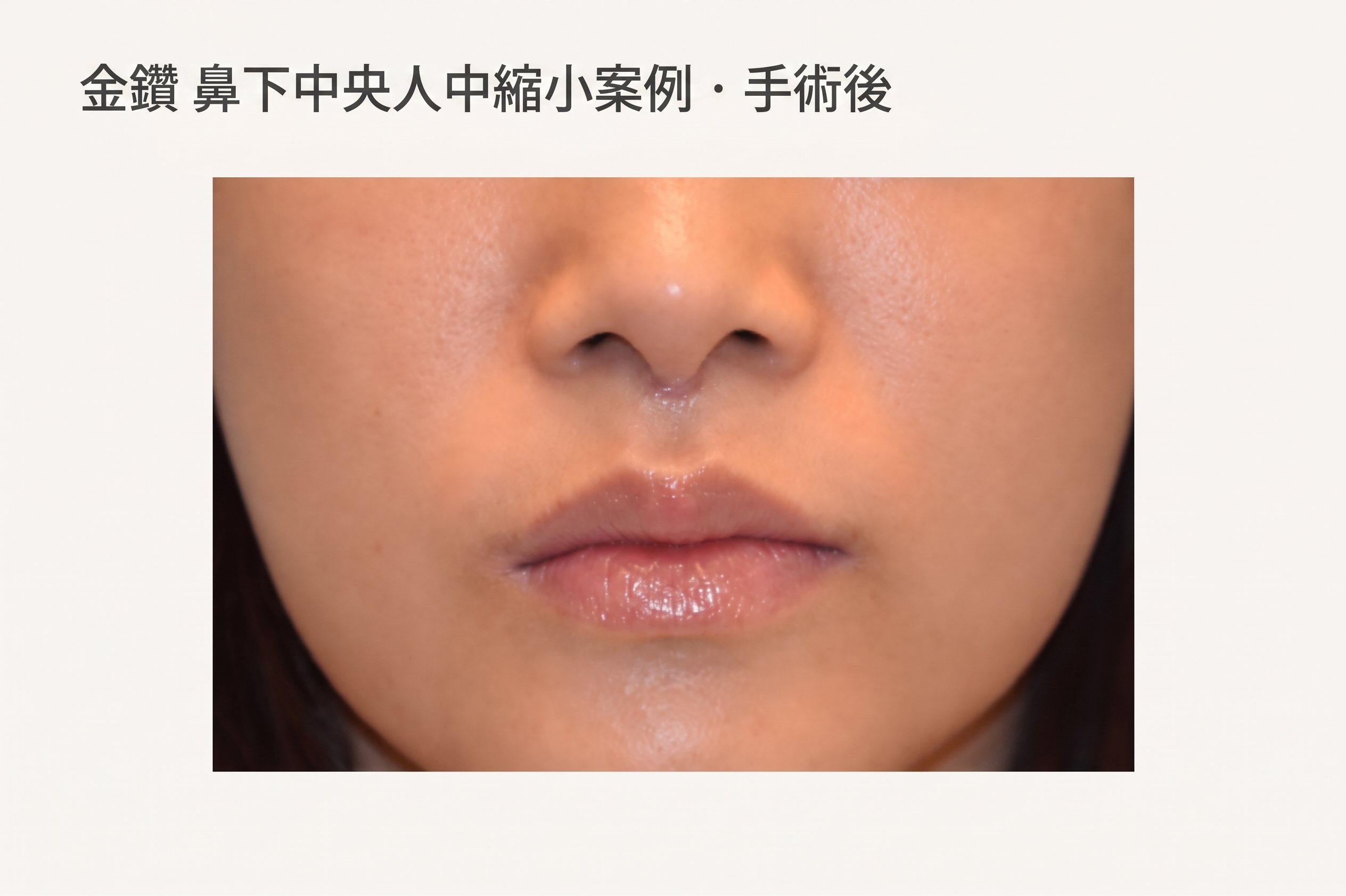 鼻小柱與上唇位置分析案例