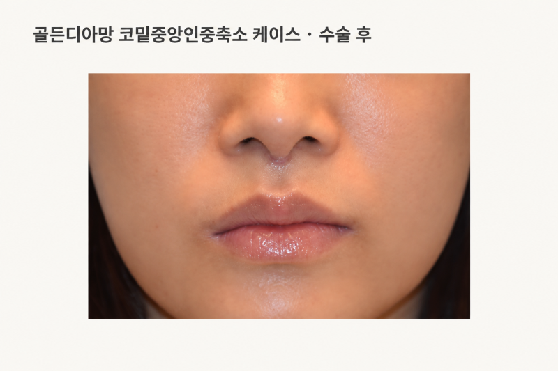 3D 무흉인중축소·비주인중축소, 누구에게 잘 맞을까요? 사진 5