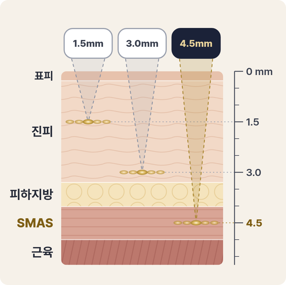 울쎄라는 얼굴 안쪽 어디까지 닿을까 사진 2