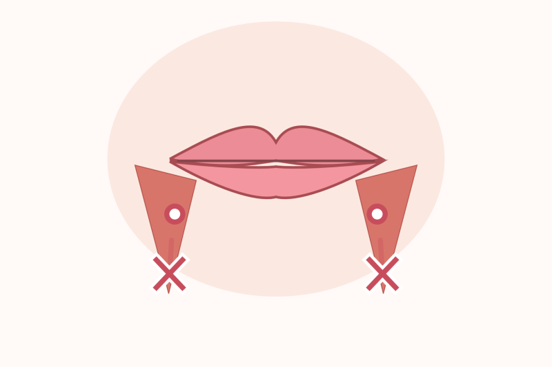 Botox khóe miệng và filler khóe miệng khác nhau thế nào? 사진 3