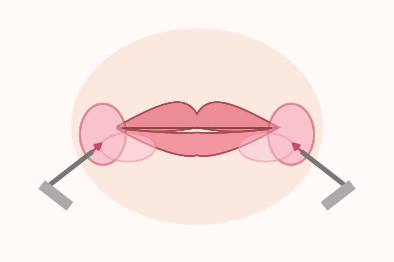 Botox khóe miệng và filler khóe miệng khác nhau thế nào? 사진 5