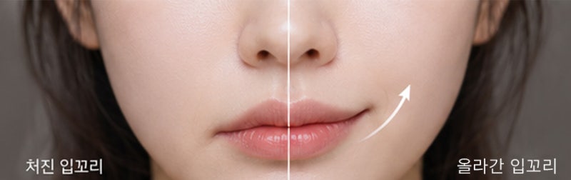 Botox khóe miệng và filler khóe miệng khác nhau thế nào?