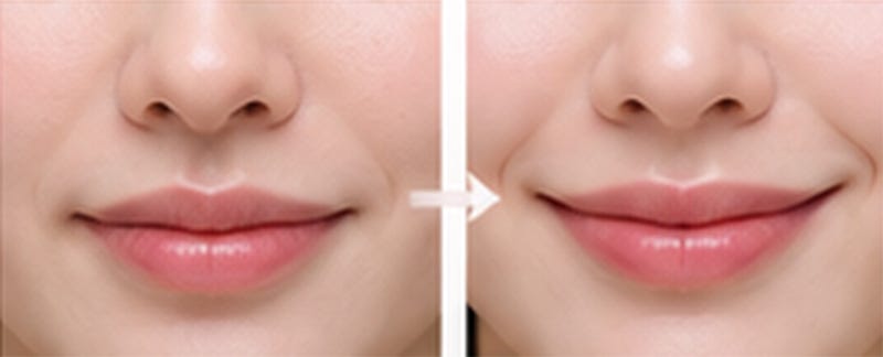Botox khóe miệng và filler khóe miệng khác nhau thế nào? 사진 4