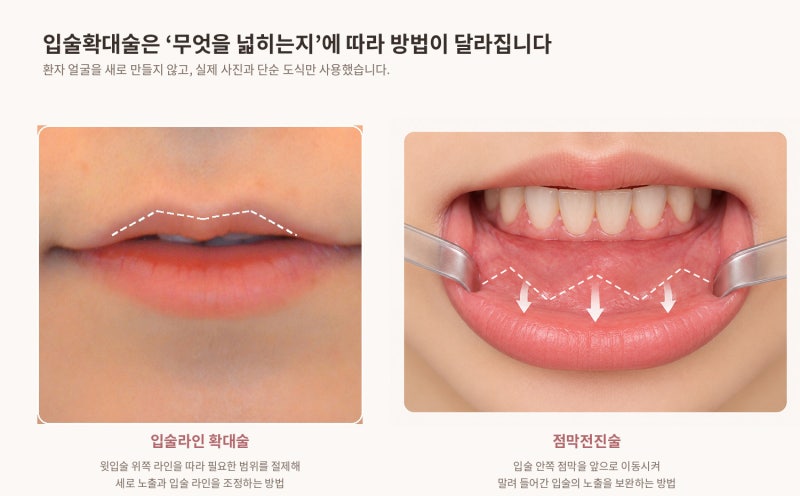 얇고 말린 윗입술, 필러로만 채우면 될까요? | 입술확대술 실제 케이스 리뷰 사진 5