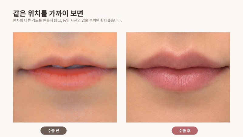 얇고 말린 윗입술, 필러로만 채우면 될까요? | 입술확대술 실제 케이스 리뷰