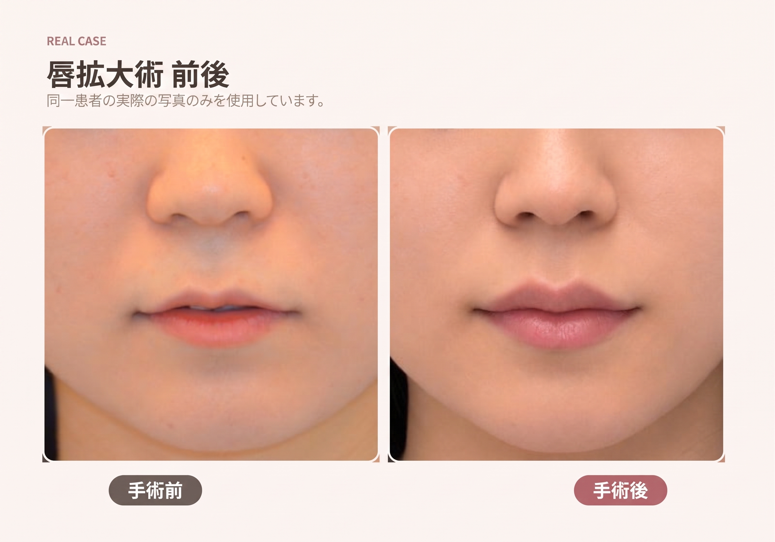 薄くて内側に巻き込んだ上唇、フィラーだけで満たせばいいのでしょうか?|口唇拡大術 実際の症例レビュー