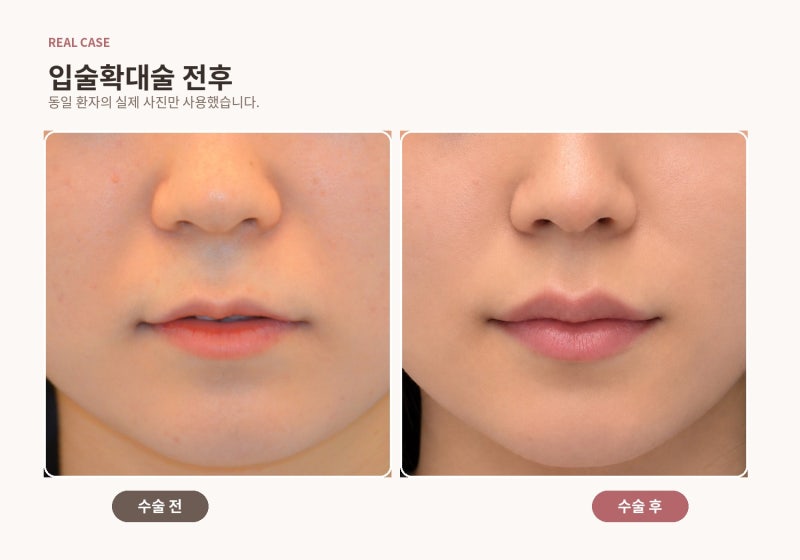 얇고 말린 윗입술, 필러로만 채우면 될까요? | 입술확대술 실제 케이스 리뷰
