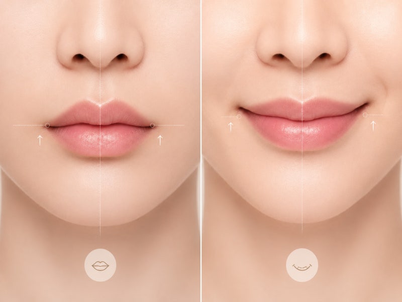 입매 재수술은 어떻게 계획해야 할까요? 가로길이·표정·흉터까지 함께 보는 이유 사진 3