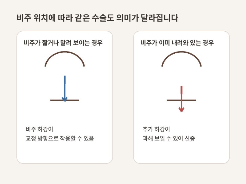 코밑중앙인중축소를 잘 하지 않는 이유 사진 5
