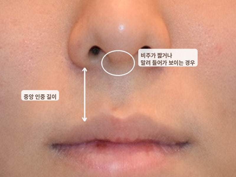 코밑중앙인중축소를 잘 하지 않는 이유 사진 3