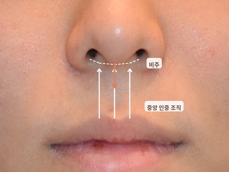 코밑중앙인중축소를 잘 하지 않는 이유