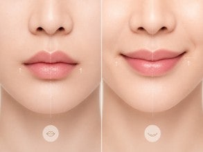 인중축소 상담에서 웃는 모습까지 확인하는 이유 사진 4